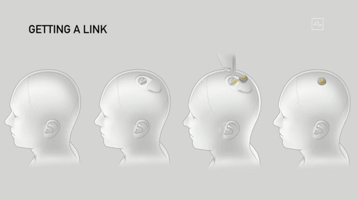 neuralink-7